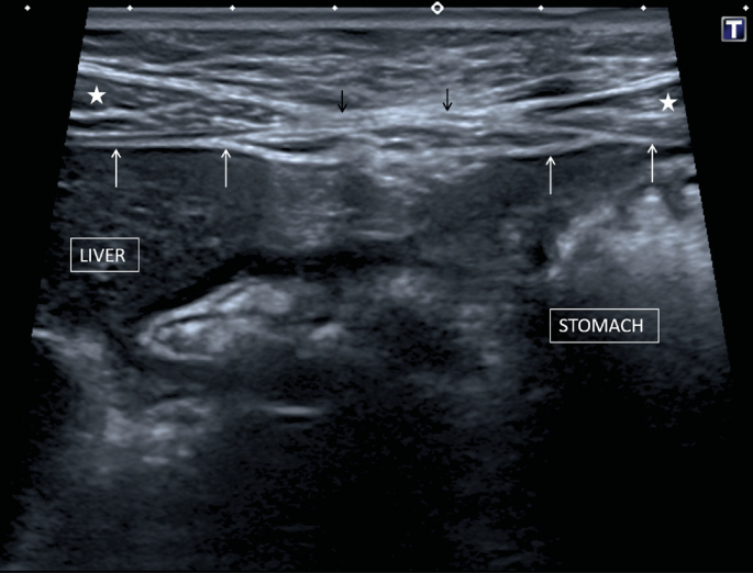 Peritoneum Definition And Examples Biology Online Dictionary