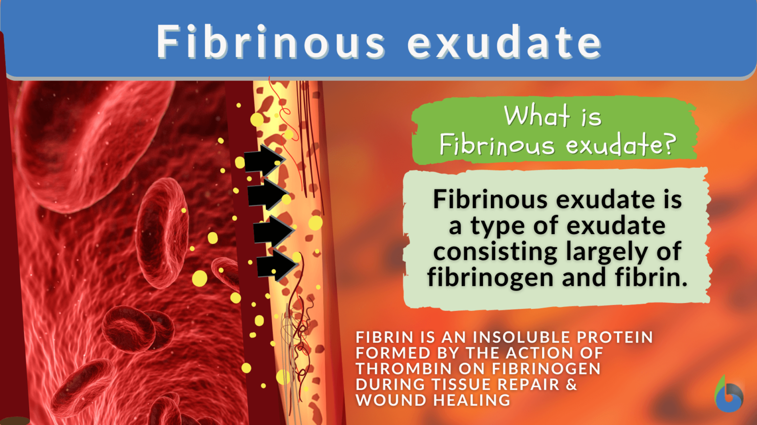 Fibrinous Exudate Definition And Examples Biology Online Dictionary