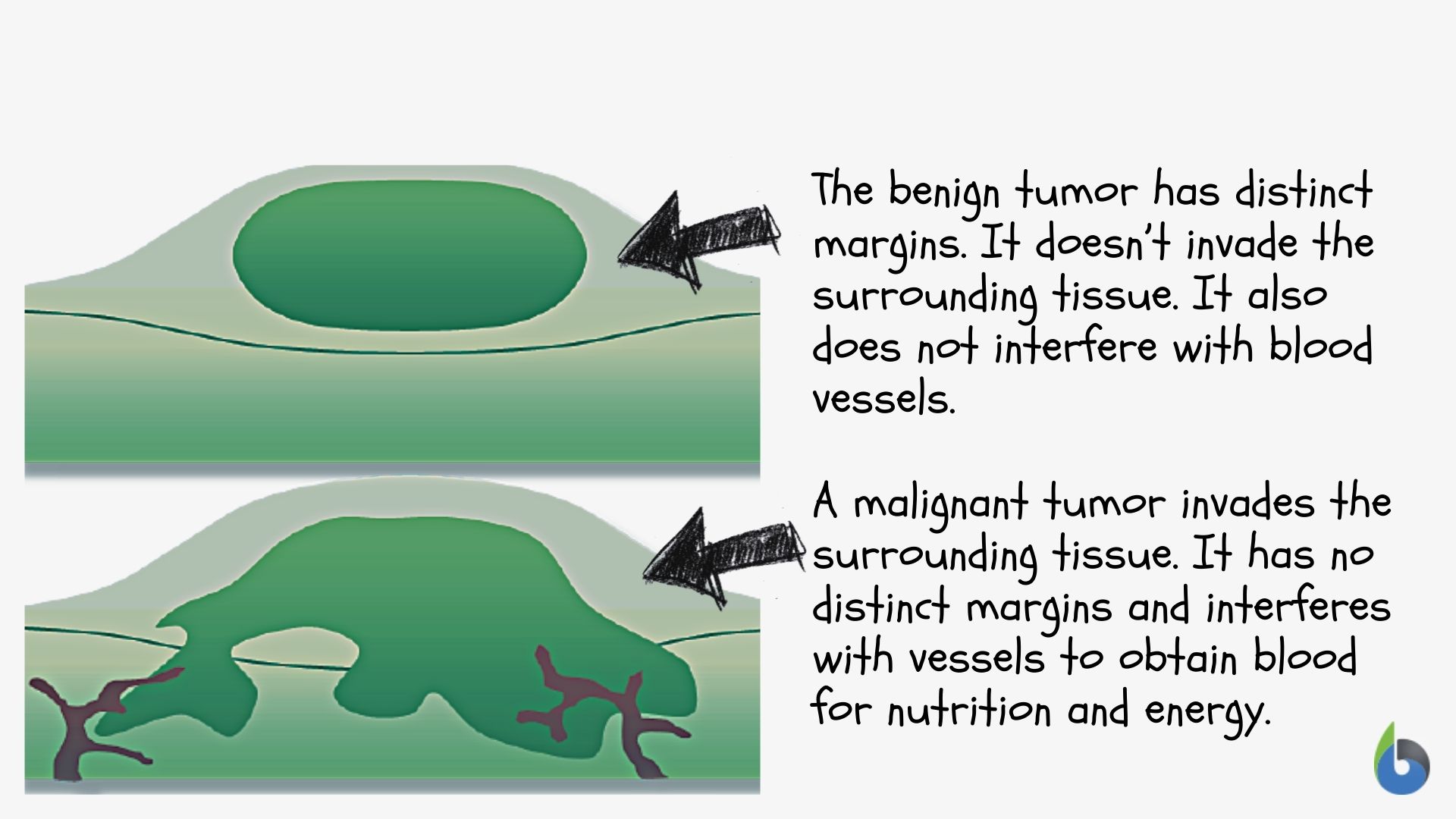 What Is The Medical Term For A Benign Tumor Made Up Of Muscle Tissue