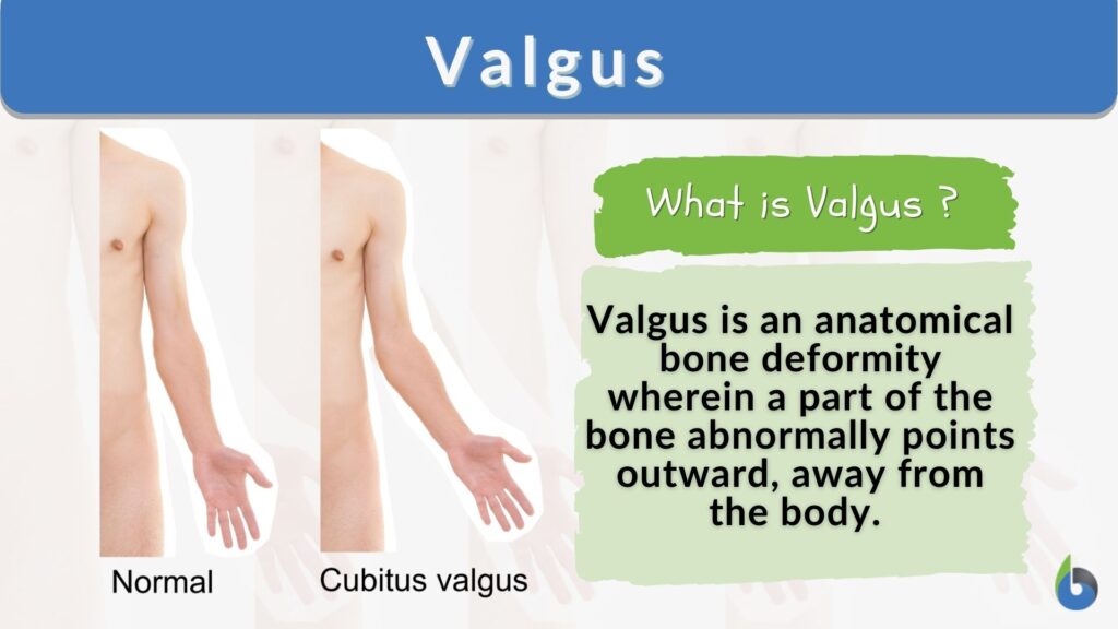 Valgus Definition And Examples Biology Online Dictionary