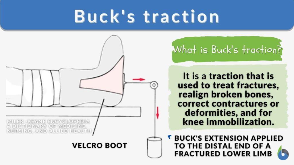 Buck's traction Definition and Examples Biology Online Dictionary