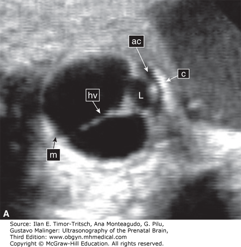 Normal fetal eye at 27 weeks