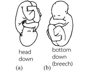 head down and bottom down (breech) fetus